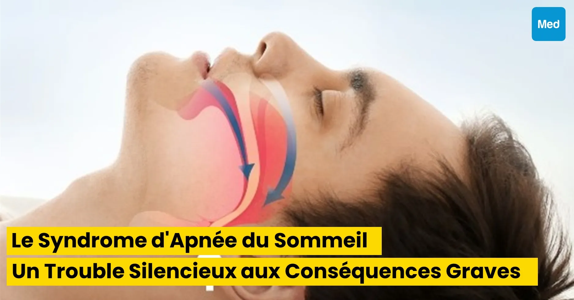 Le Syndrome d'Apnée du Sommeil : Un Trouble Silencieux aux Conséquences Graves